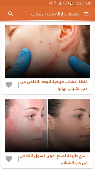 وصفات لازالة حب الشباب بدون نت應用截圖第1張
