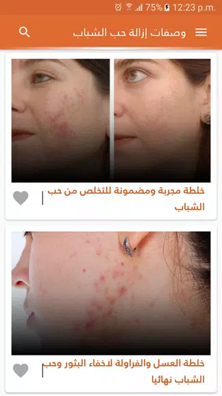 وصفات لازالة حب الشباب بدون نت應用截圖第2張